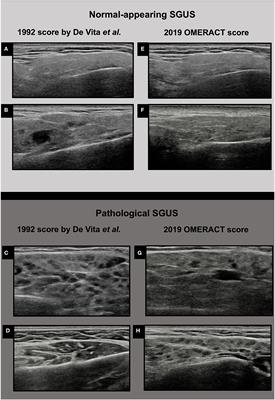 Normal-Appearing Salivary Gland Ultrasonography Identifies a Milder Phenotype of Primary Sjögren's Syndrome